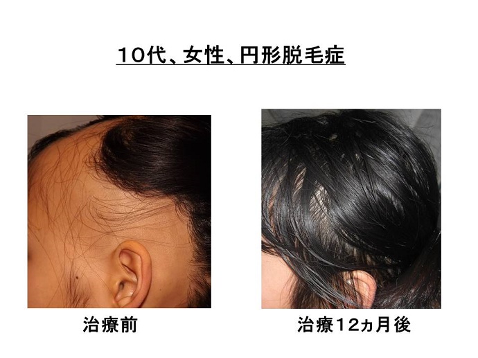 円形脱毛症　病院